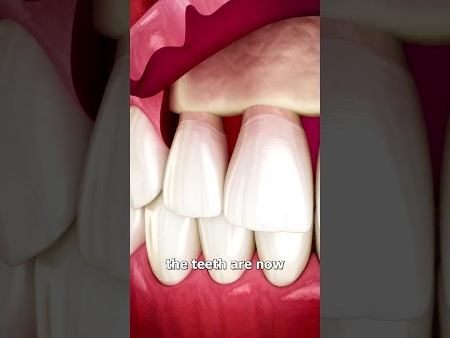 The Surgery To Reveal More Teeth 