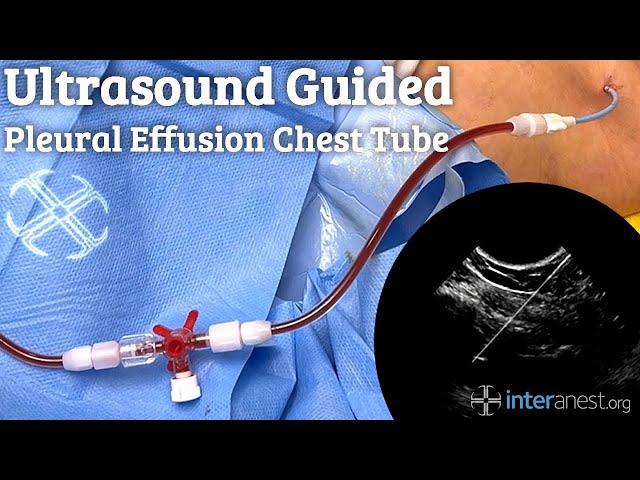 Ultrasound guided Pleural Effusion Chest Tube