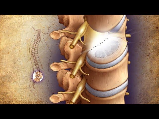 Mayo Clinic Minute: Minimally invasive surgery solutions for bad backs