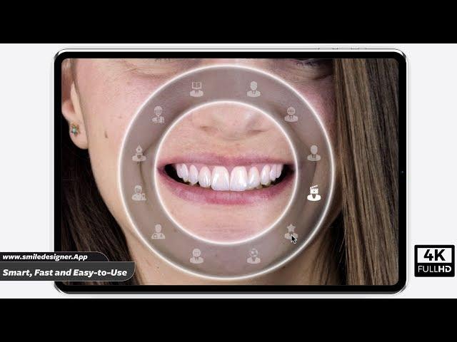 Smile Designer App 4K - AI Smile Design Software