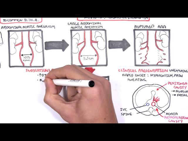 Abdominal Aortic Aneurysm - Summary