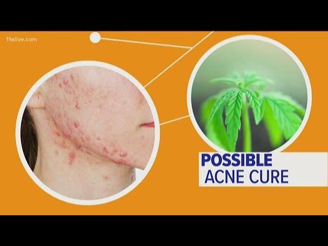 Can CBD oil really help with acne?