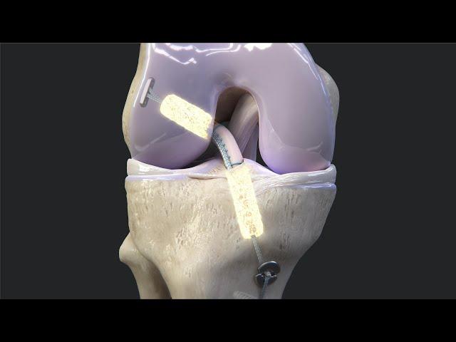 Arthrex BioACL™ Technique