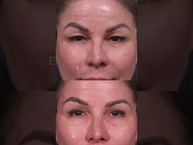 Stoker discusses “the Traceless facelift” @DrDavidStoker #beverlyhills #plasticsurgery #surgeons