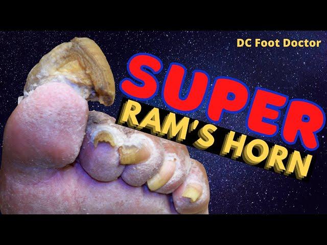 Super Ram's Horn Toenail: Super Challenging