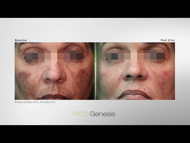 Enlighten PICO Genesis laser by Cutera