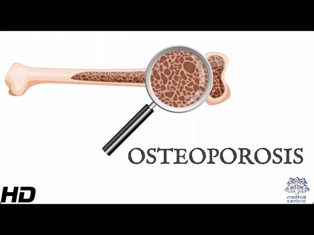 Osteoporosis: Everything You Need To Know