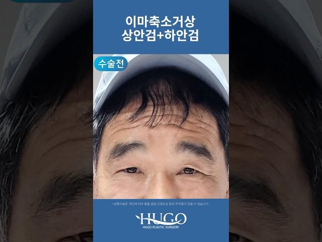 이마거상 수술로 이마주름 완벽 제거! 한 달 후 변화는?