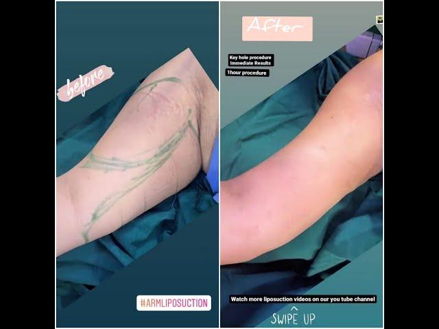 Arm Liposuction Before & After #keyhole #1hourprocedure #shorts