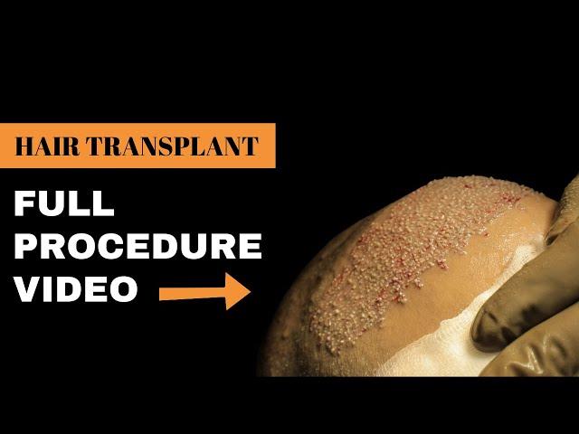 Step by Step DMC- Golden Touch®️ Hair Transplant Surgery | DMC Trichology