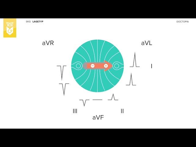 Die Bestimmung des Lagetyps im EKG