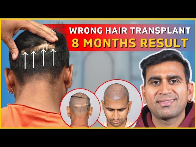 FUE Hair Transplant Results | QHT FUE Hair Transplant Results | FUT | Repair Hair Transplant | QHT