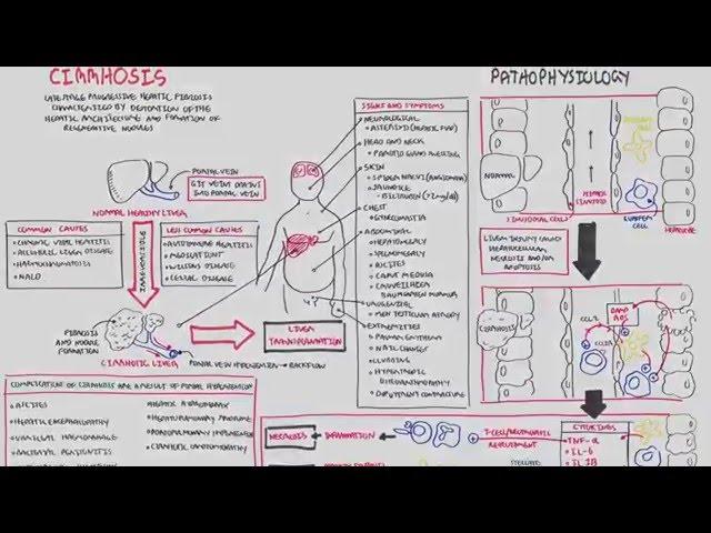 Liver Cirrhosis (SandS, Pathophysiology, Investigations, Management)