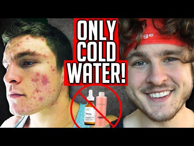 Caveman Regimen Can Eliminate Acne (FROM EXPERIENCE)