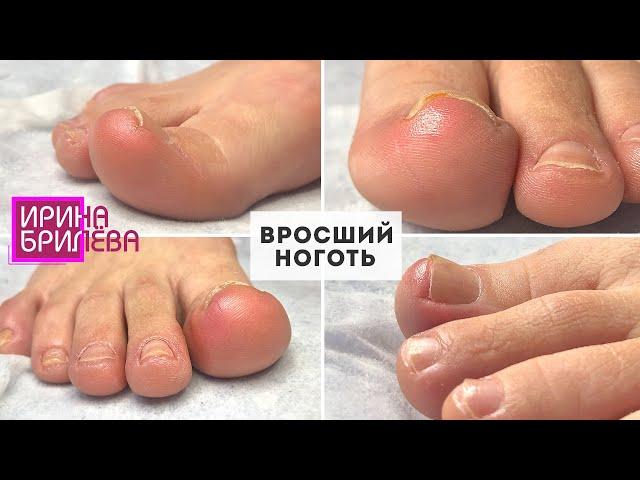 Педикюр  Вросший ноготь  Обработка пальцев ног  Ирина Брилёва