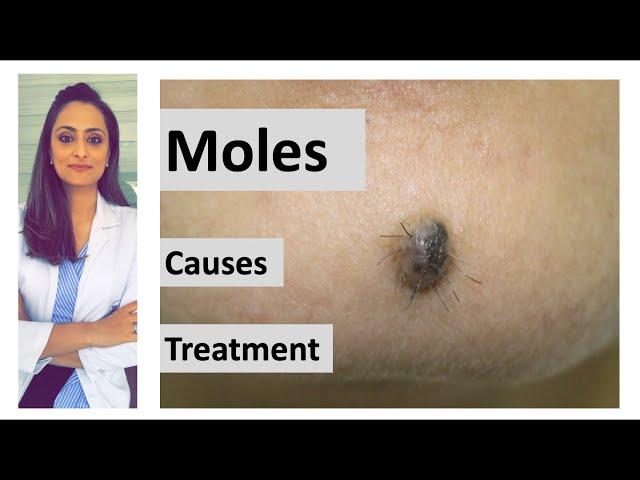 How to remove a mole | Mole: causes  & removal | home remedy | Dermatologist | Dr. Aanchal Panth