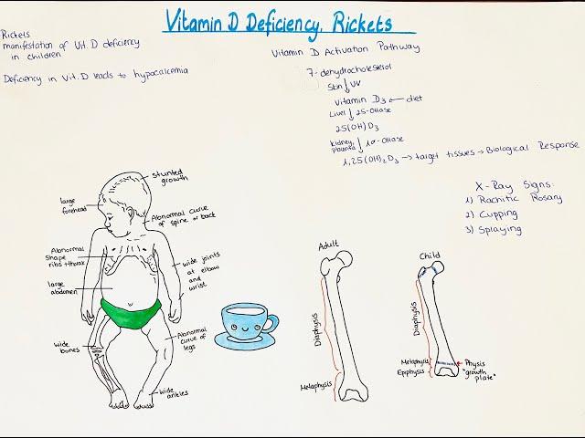 Rickets, Vitamin D deficiency in children! Bone manifestation, signs and symptoms. High yield info