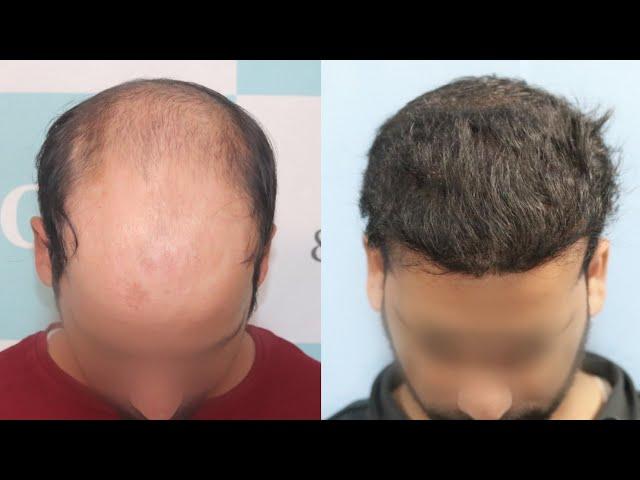 Best Hair Transplant Result 2021 || NW Grade VI || 4,975 Grafts || Regrow Clinic Haridwar