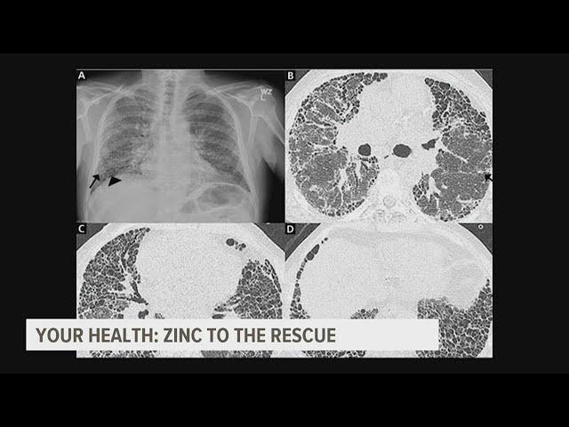 Could zinc be the key to stopping this deadly lung disease?