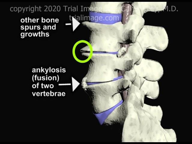 Degenerative Disc Disease of the Spine (ALIF Part 1) - Animation by Cal Shipley, M.D.