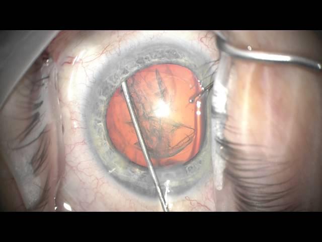 phacotrabectome in narrow angle, low pressure glaucoma and floppy iris #2