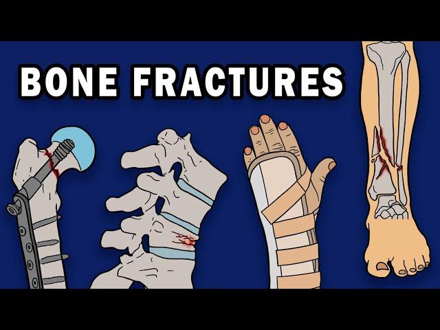 BONE FRACTURES