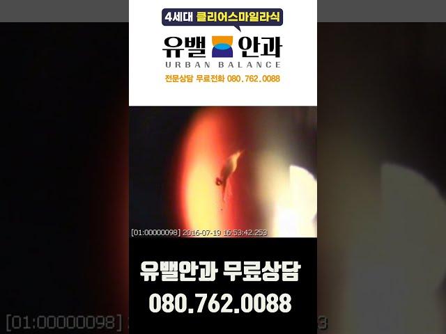 인천 유밸안과 ｜내 눈에 벌레?  비문증(날파리증)치료영상