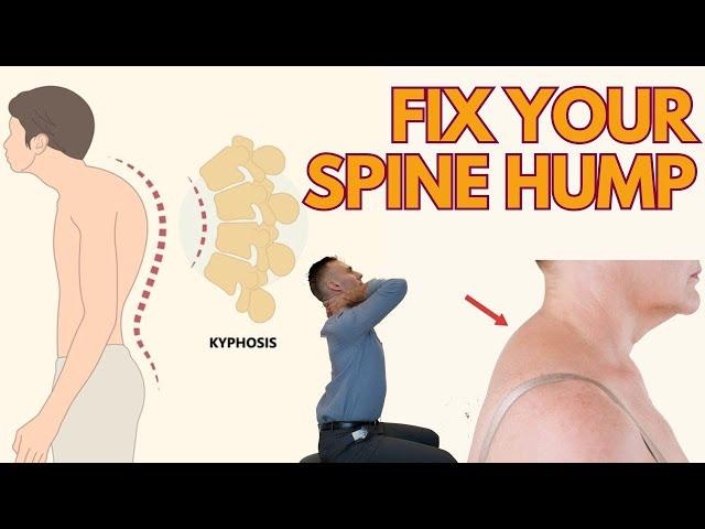 Back Hump Exercises and Posture Fix | KyphosisTreatment Toronto