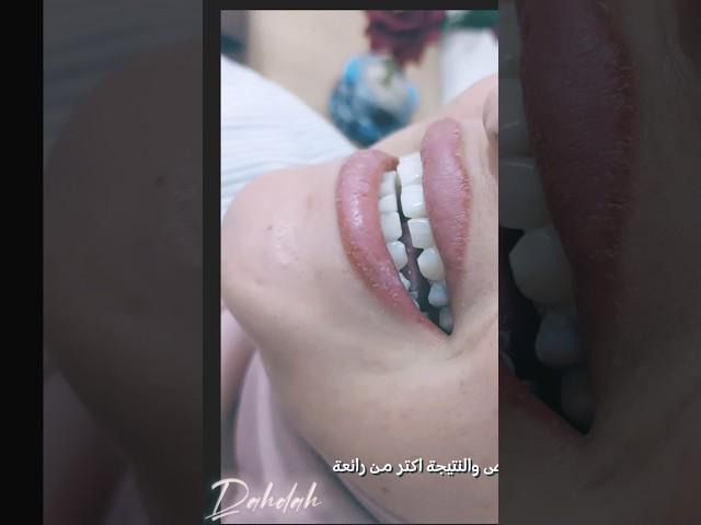 Teeth whitening @DrduaaShokrydahdah-us5zk #dentist #hollywoodsmile #syria #beforeandafter #اكسبلور