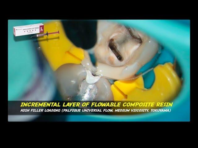 rewalling pre endodontic build up palfique universal flow tokuyama bioclear matrix mandibular molar