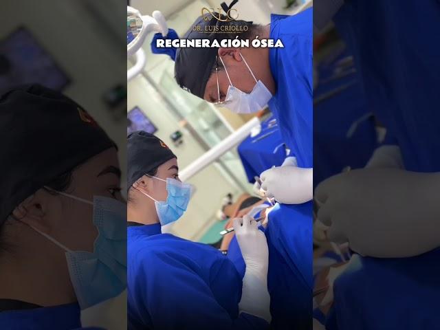 “Regeneración ósea: el primer paso hacia un implante dental perfecto”🪡