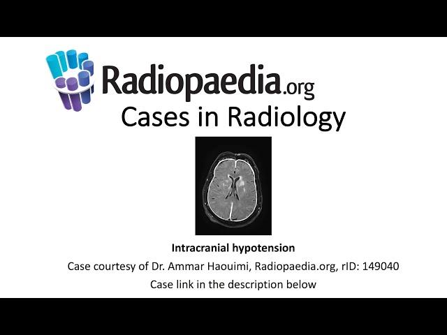 Intracranial hypotension (Radiopaedia.org) Cases in Radiology