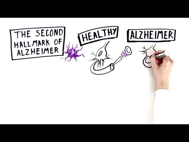 Alzheimer's Disease: The Basics | Being Patient