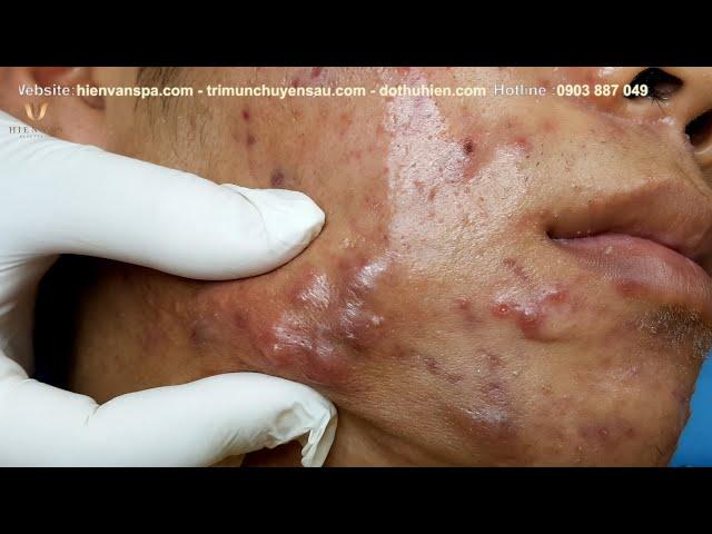 Poor Younger with many "Cysts" at hien van spa|347|Trọng Hải