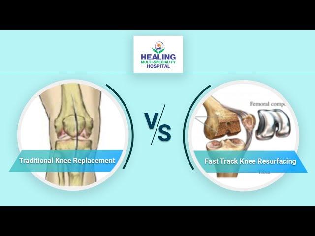 Knee Arthritis | Traditional Knee Replacement v. Fast Track Knee Resurfacing | Healing Hospital