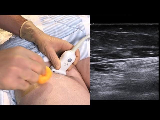 Ultrasound guided saphenus nerve block