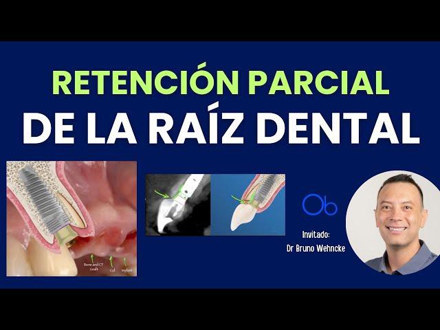 Retención parcial de la raíz dental  con Dr Bruno Wehncke