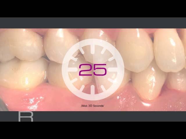 Treatment of deep periodontal pocket, Dr Laura Matrigiani and Prof Andrea Pilloni, Italy