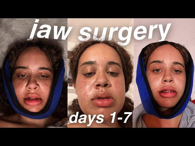 first week of jaw surgery recovery: i feel more dead than alive... (days 1-7)