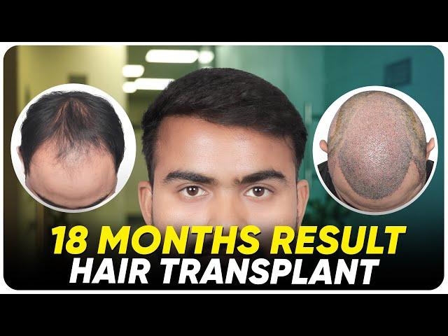 Hair Transplant in Agra | Best Results & Cost of Hair Transplant in Agra