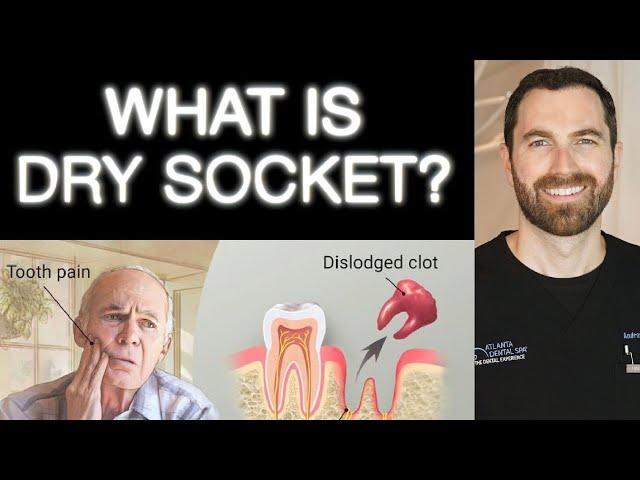 What is Dry Socket? Symptoms and how to fix it! (2022) Top dentist!