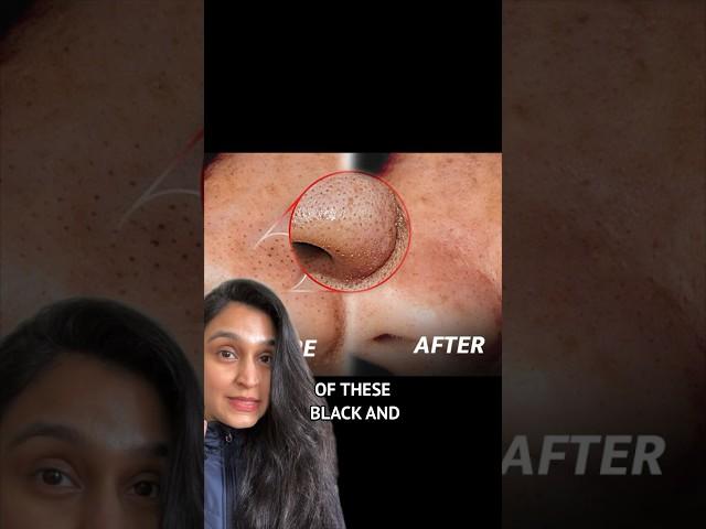 How to treat BLACKHEADS?? #skincare #blackheads