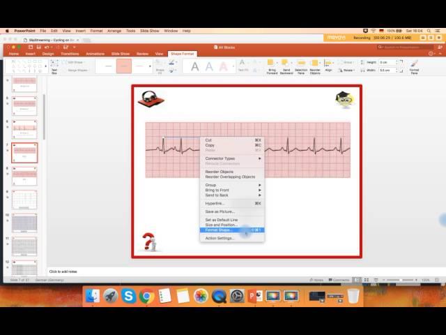 Ekg Podcast 25 of 59. AV Blokády 4. Časť