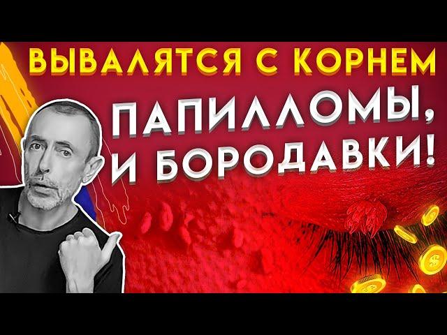 ВЫВАЛЯТСЯ С КОРНЕМ ПАПИЛЛОМЫ, БОРОДАВКИ! 5 Наилучших Копеечных Способов!