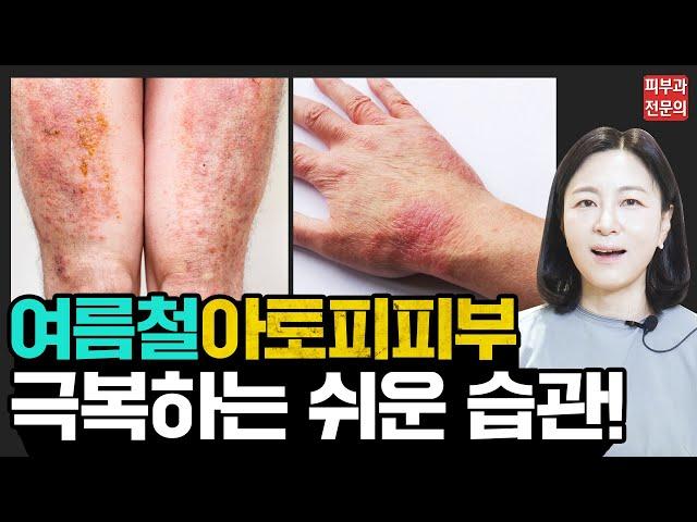 아토피가 여름에 더 심해지는 이유!? 아토피피부염 환자들이 모르는 여름철 관리법5가지 | #아토피피부염 #아토피치료 #아토피가려움