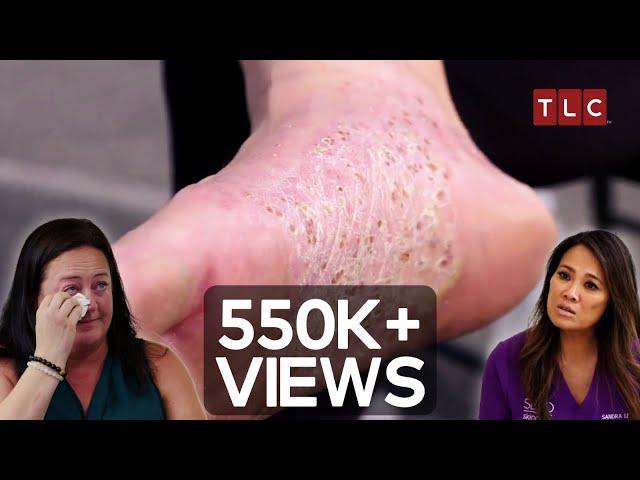 The 23-Year Struggle to Find a Solution! | Dr Pimple Popper TLC