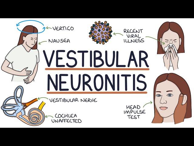 Understanding Vestibular Neuronitis