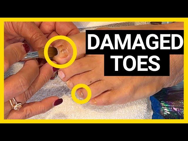 Damaged Toe Nails Fixed with Acrylic | Nina's Nails