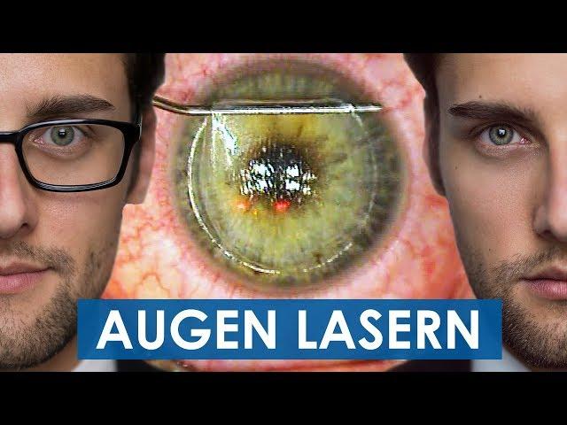 Augen lasern: Video von der ganzen Operation - Femto LASIK OP | Teil 3