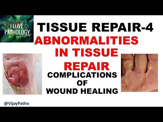 TISSUR REPAIR Part 4: Abnormalities in tissue repair